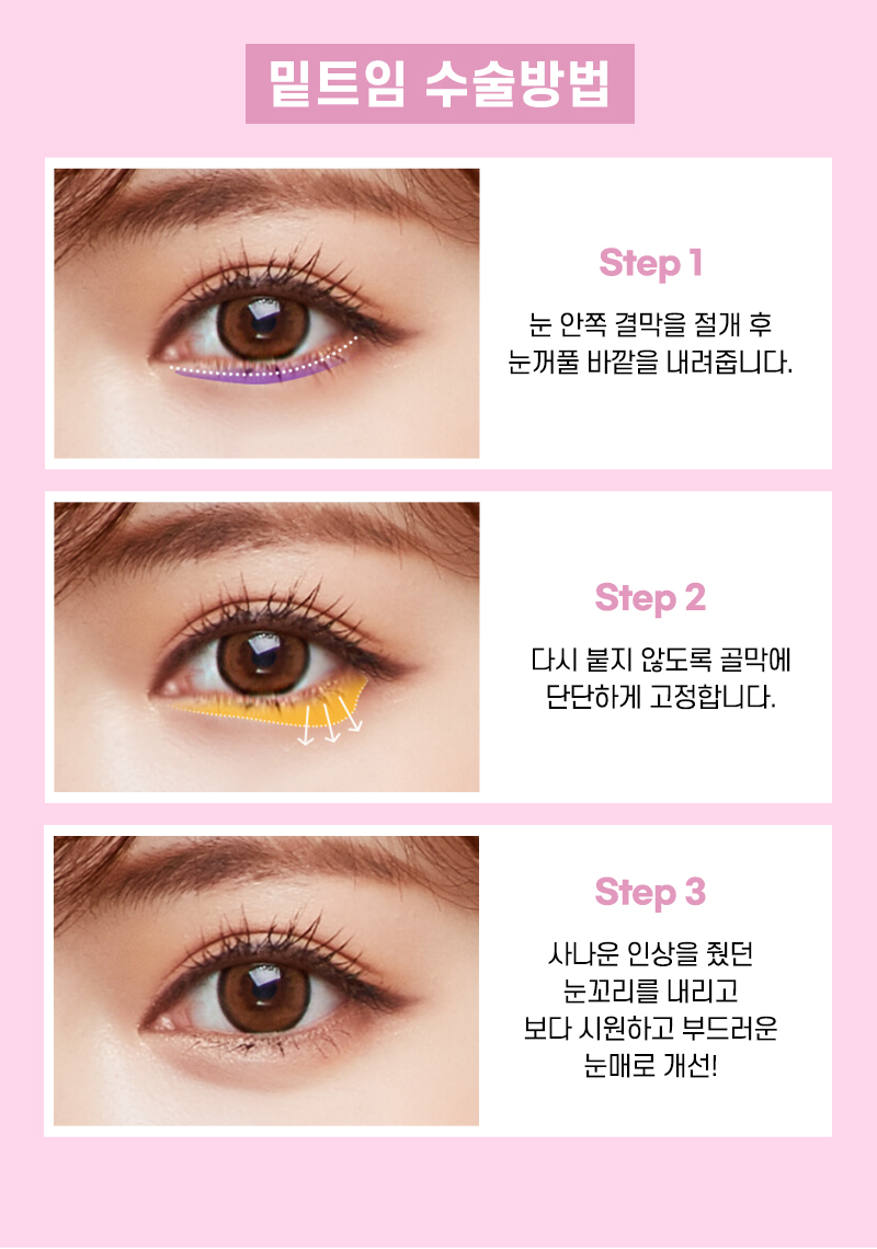 확대한듯 크고 또렷한 눈, 뷰성형외과 눈트임수술 관련 이미지 8