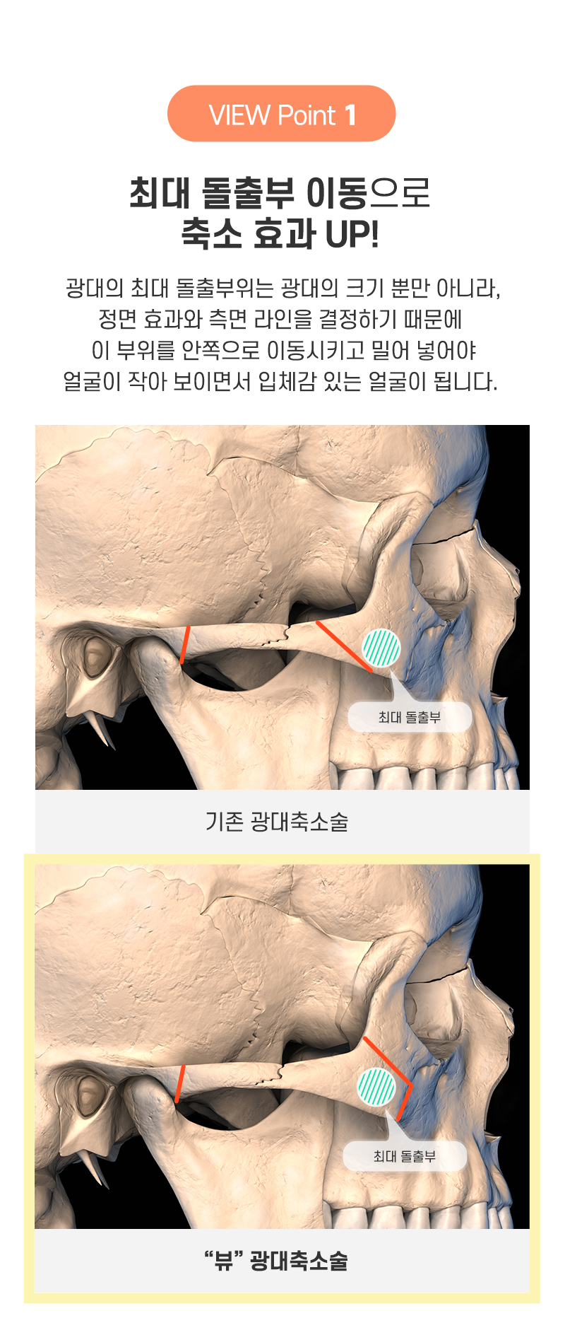 광대축소, 부작용은 줄이고 효과는 높이고 싶다면 관련 이미지 7