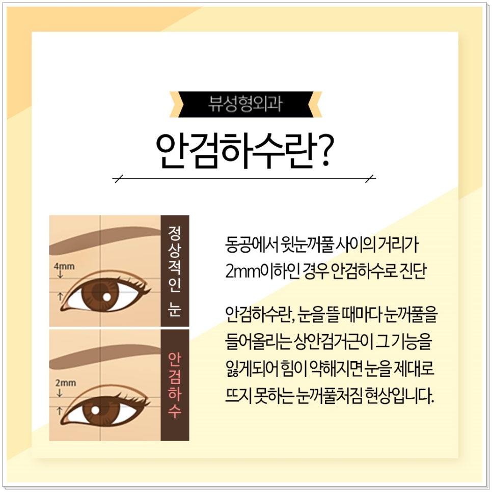 졸린눈, 뷰성형외과 눈매교정으로 또렷하게! 관련 이미지 5