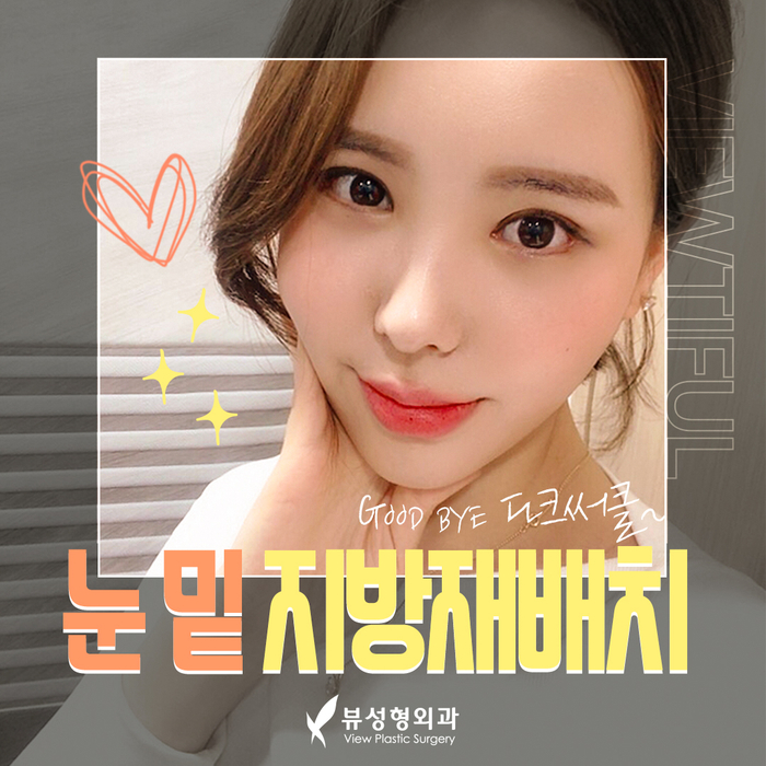 나만의 눈성형을 위한 수술방법 알아보기 관련 이미지 11