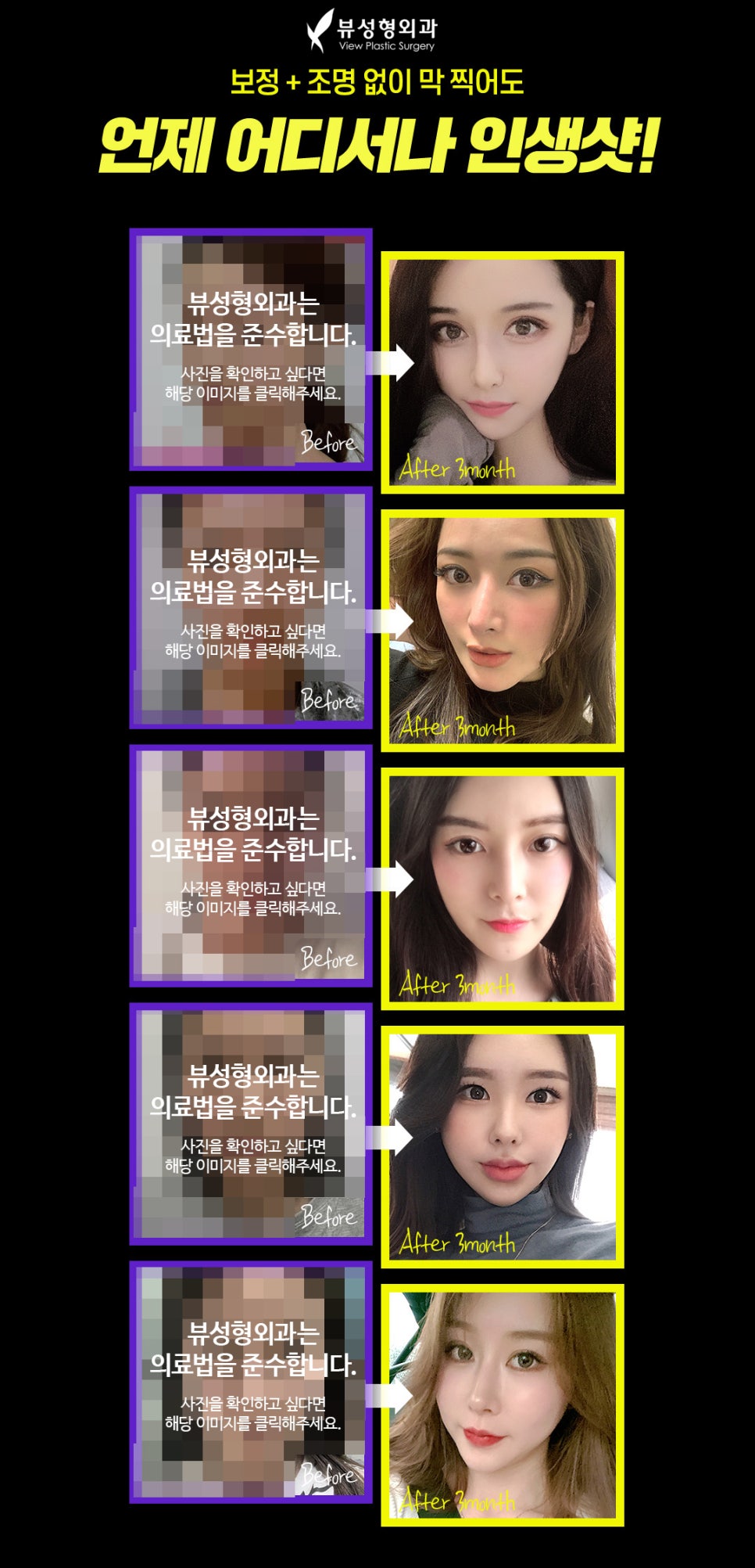 안면윤곽재수술 후기 | 발품 꿀팁 관련 이미지 4