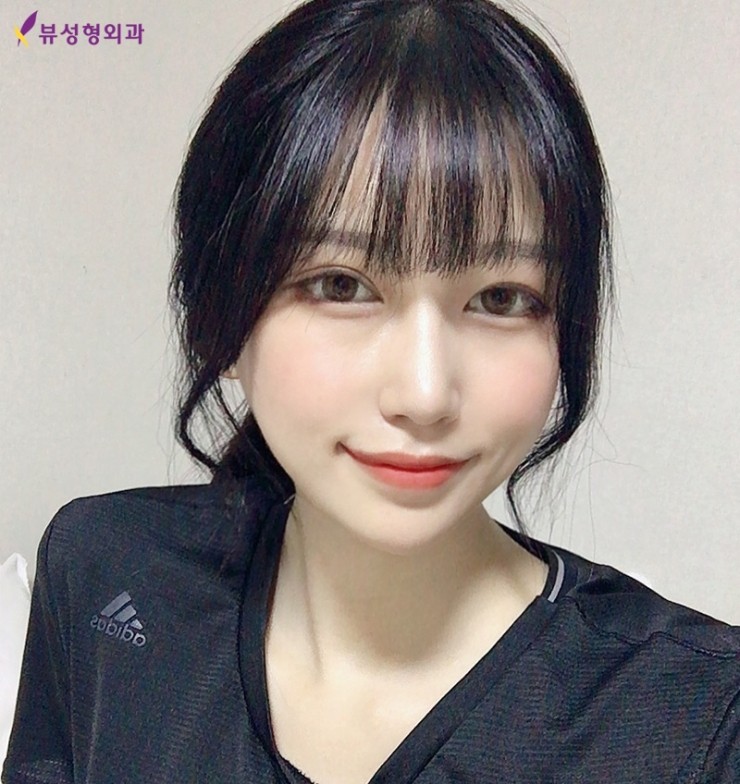 광대축소술 눈치없는 광대 쏙-지워볼까요? 관련 이미지 3