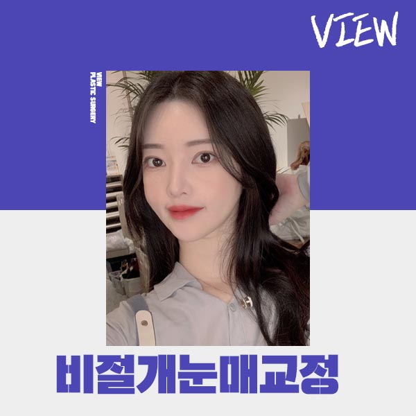조화로운 비절개눈매교정 하고 싶다면 관련 이미지 3