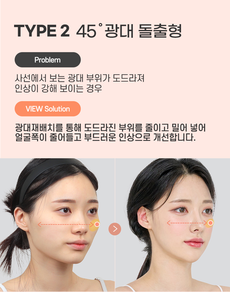 광대축소 하기전에 필수로 알아야 할 것은? 관련 이미지 6