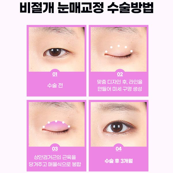 안검하수눈매교정 쌍꺼풀수술 차이점은? 관련 이미지 7