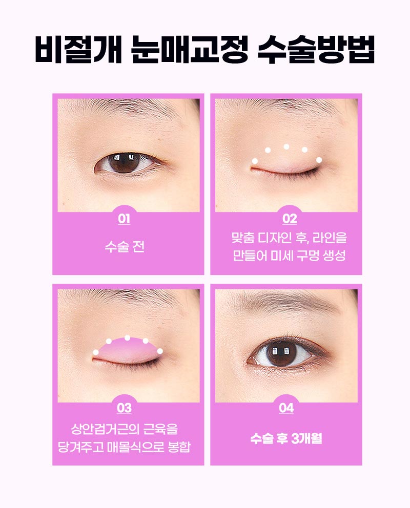 조화로운 비절개눈매교정 하고 싶다면 관련 이미지 5