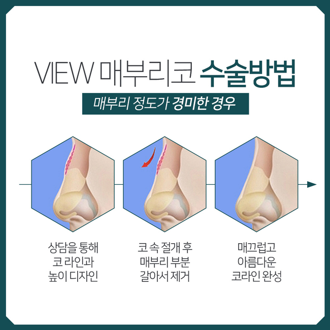 뷰성형외과 매부리코교정, 포인트는? 관련 이미지 6