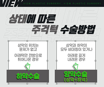 긴얼굴성형 미용과 기능 모두 잡길 원한다면 관련 이미지 6