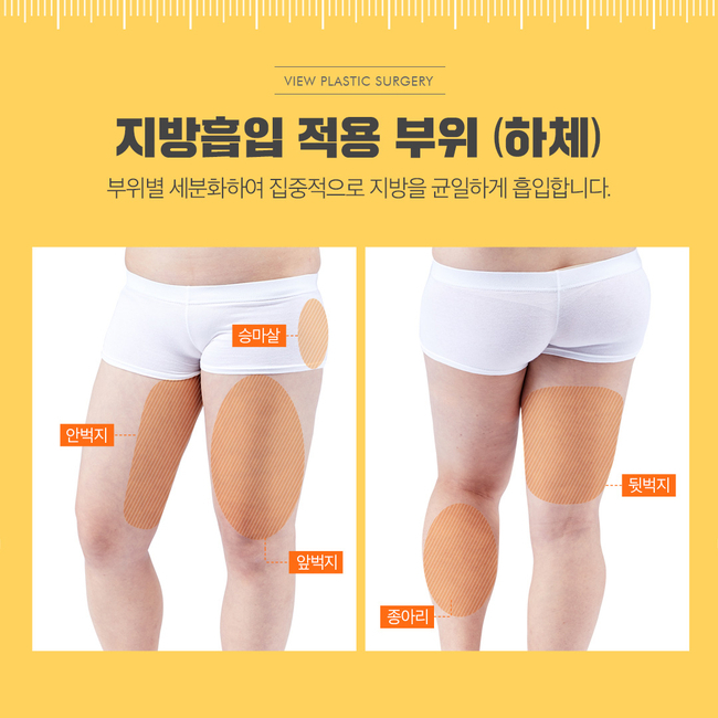 팔뚝지방흡입 슬림한 바디라인 뷰성형외과라면 관련 이미지 3