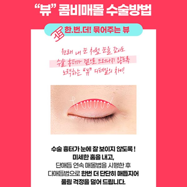 쌍꺼풀수술종류 알아보기 관련 이미지 5