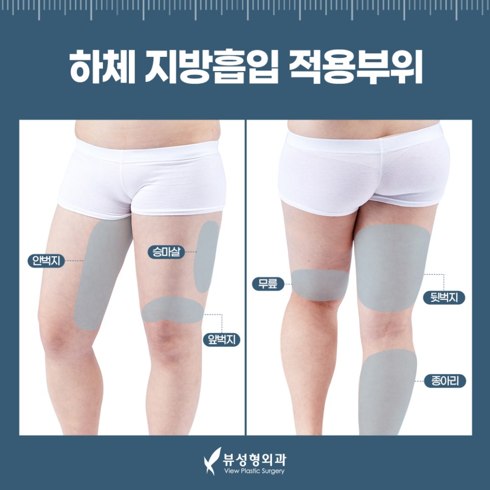 지방흡입, 체중감량술이 아닌 체형교정술 관련 이미지 9
