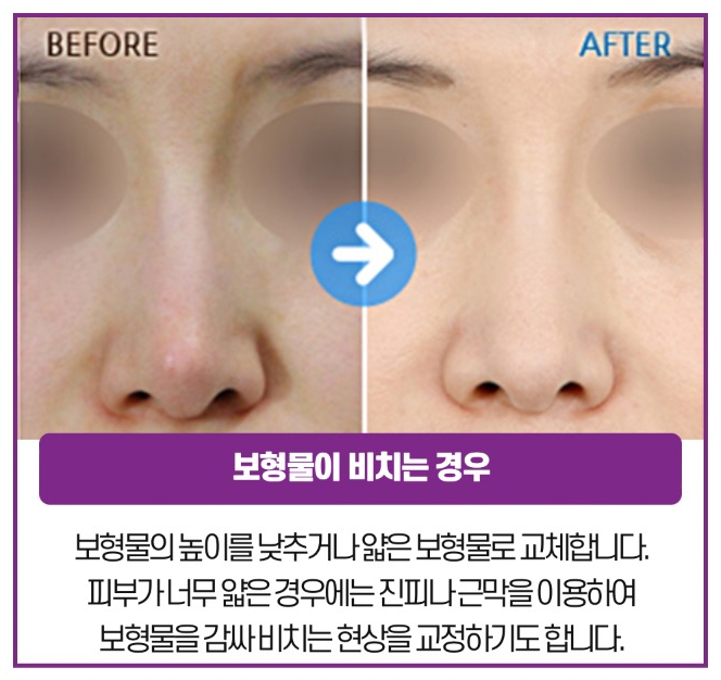 완성도 높은 코를 위한 체계적인 플랜, 코재수술 관련 이미지 6