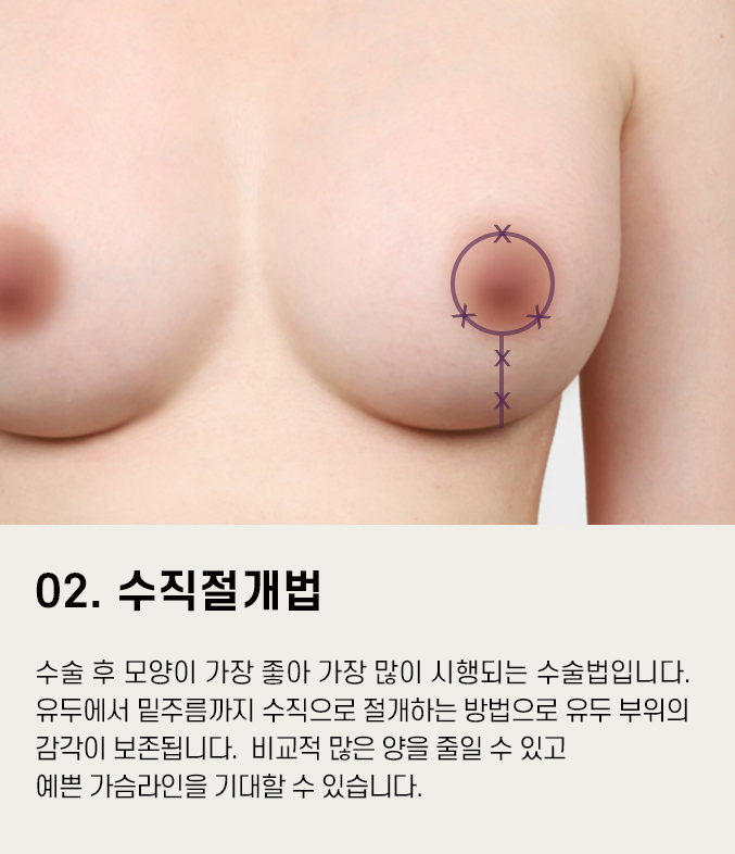 처진가슴수술 고민거리를 줄이고자 한다면 관련 이미지 11