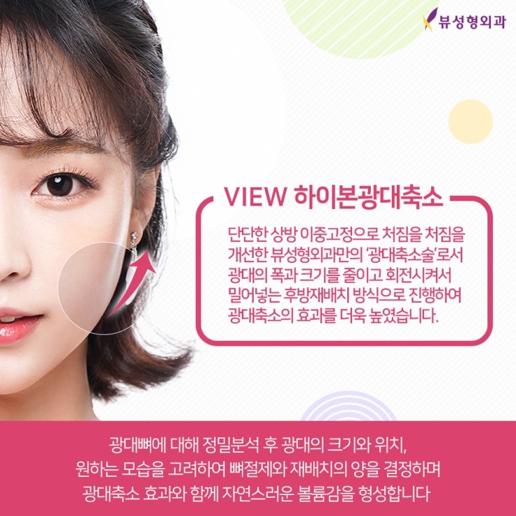 광대축소술 눈치없는 광대 쏙-지워볼까요? 관련 이미지 5