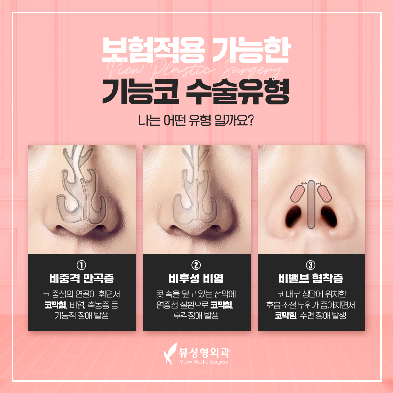 기능코성형, 누군가에겐 꼭 필요한 성형 관련 이미지 4