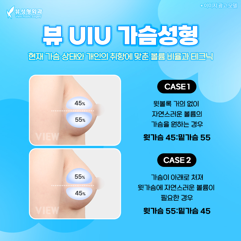 가슴수술, 부작용은 낮추고 안정성과 자연스러움을 높일려면? 관련 이미지 3