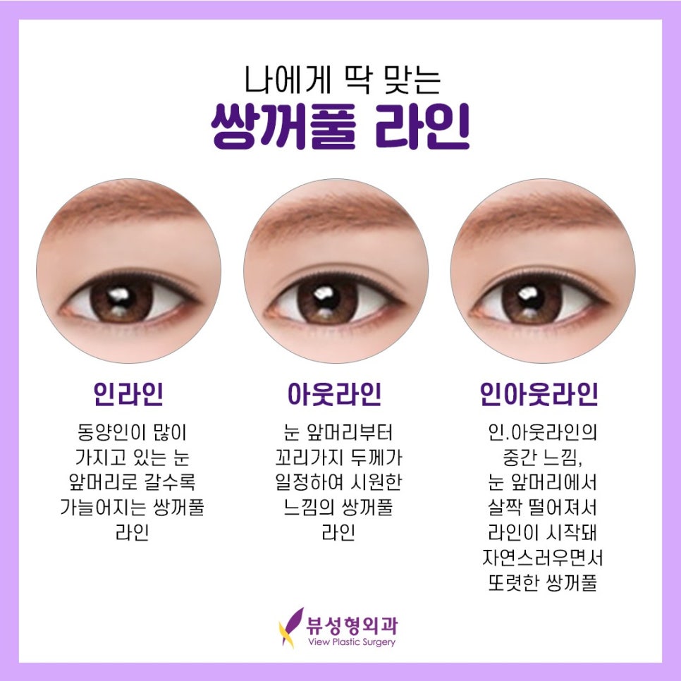 매몰법 잘 하는 곳 찾는다면 뷰 성형외과 관련 이미지 3