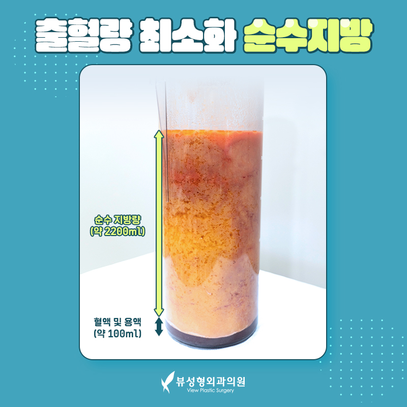 단기간 눈에 띄는 지방 감량 방법, 지방흡입 관련 이미지 5