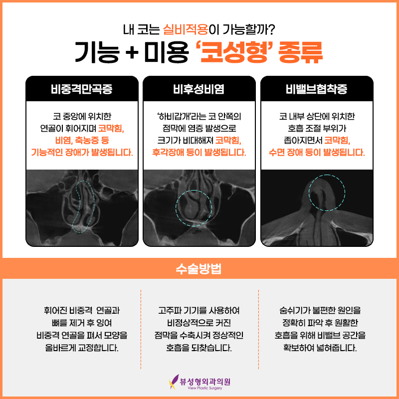 예술적인 코라인부터 비염수술까지 잘하는 뷰성형외과 관련 이미지 3