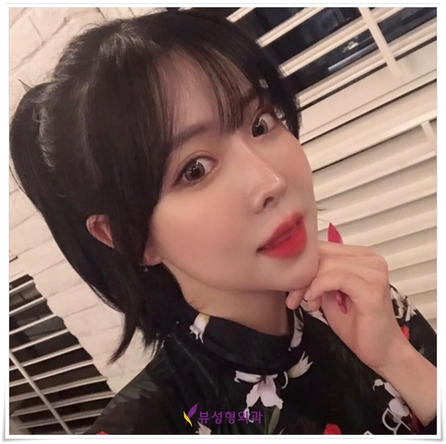 뷰성형외과 코성형종류 나에게 적합한 방법은? 관련 이미지 5