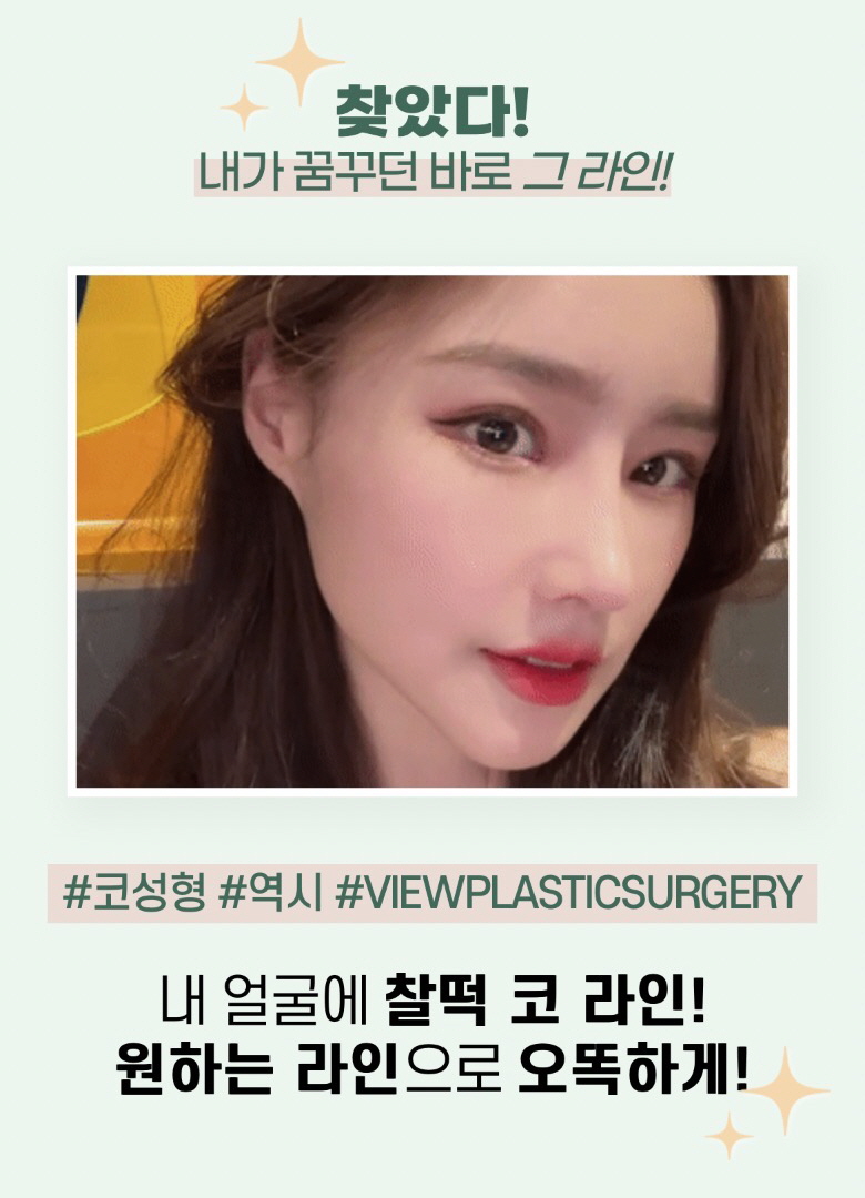 울퉁불퉁한 콧대를 매끈하게, 뷰성형외과 매부리코성형 관련 이미지 4