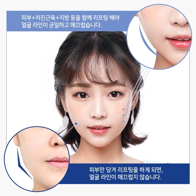 실리프팅 VS 안면거상술, 피부 상태에 맞는 맞춤리프팅 관련 이미지 15