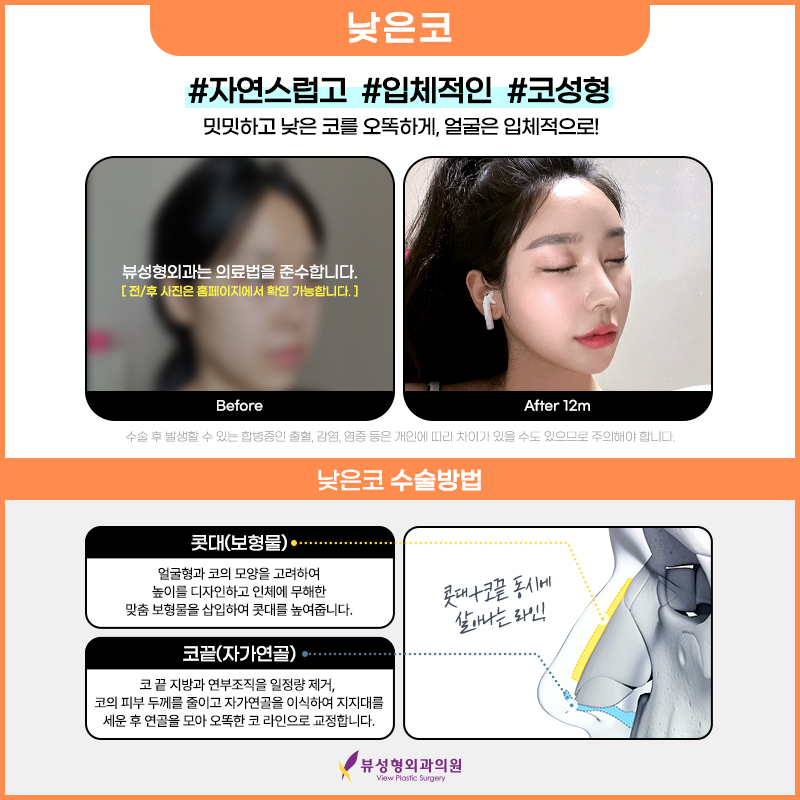 코성형, 개인별 유형에 적합한 수술방법은? 관련 이미지 4