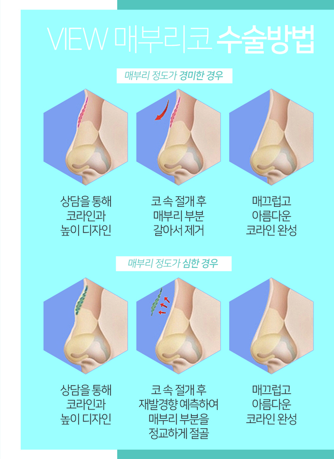 여자매부리코성형으로 여성미 한껏 뽐내봐요~! 관련 이미지 3