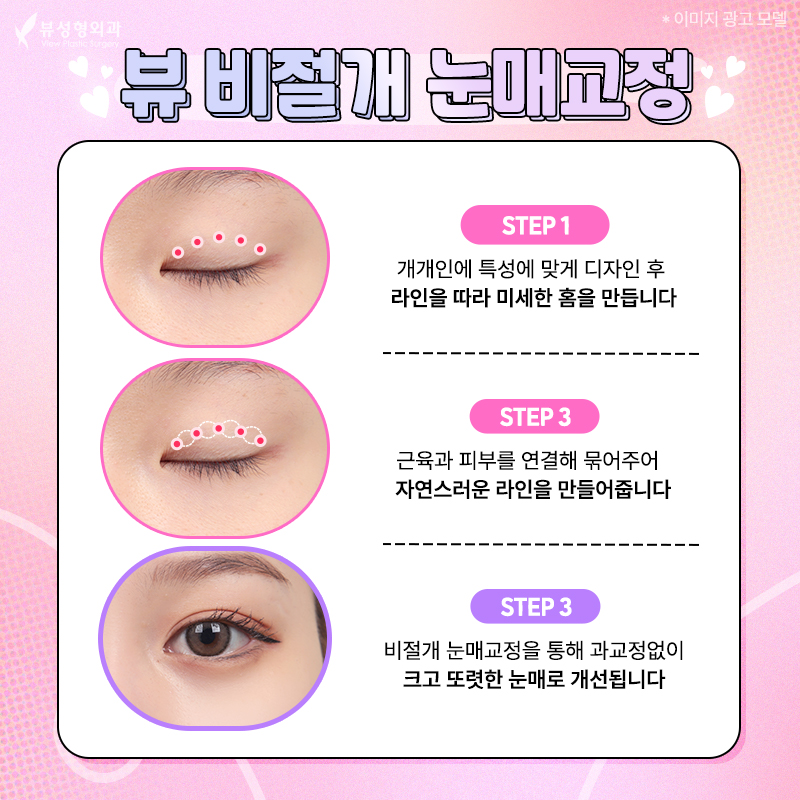 내게 맞는 눈성형 알아보기 관련 이미지 13