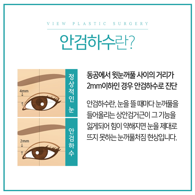 답답한 눈매 또렷해지려면? 뷰성형외과 눈매교정으로 관련 이미지 4