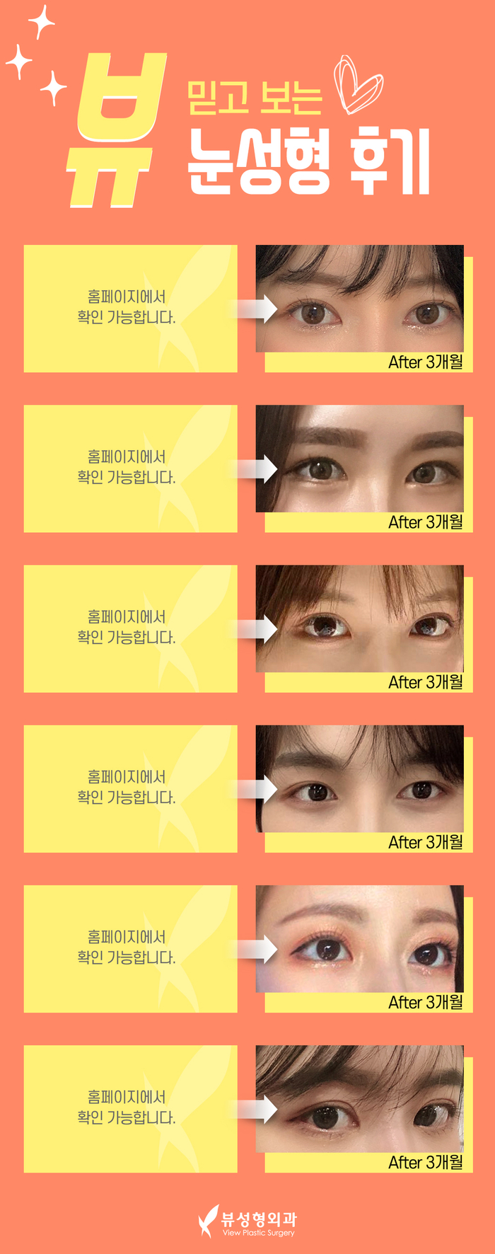 나만의 눈성형을 위한 수술방법 알아보기 관련 이미지 13