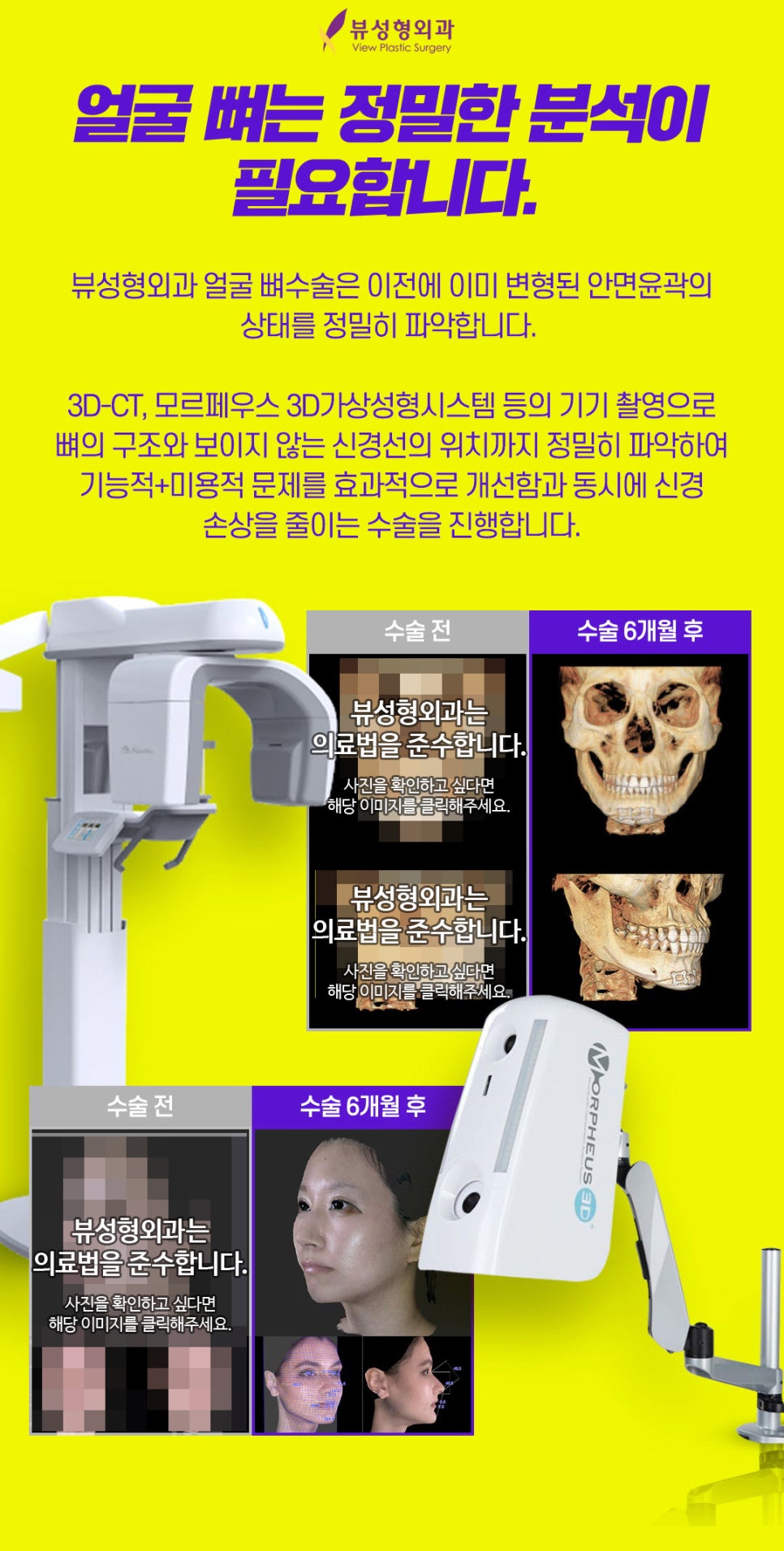 안면윤곽재수술 후기 | 발품 꿀팁 관련 이미지 6