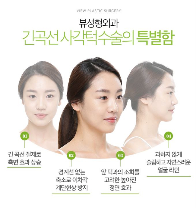 사각턱수술잘하는곳 뷰성형외과 긴곡선사각턱수술로 변화된 모습 관련 이미지 8