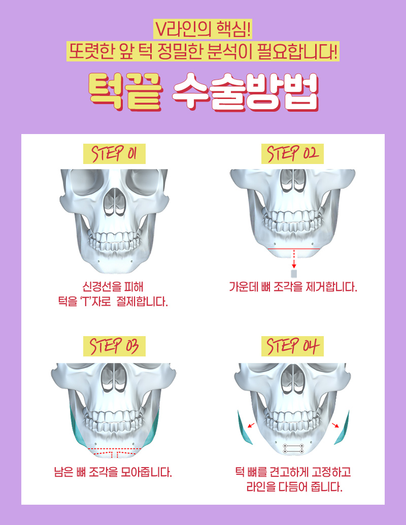 안면윤곽비용 걱정하기 보다는 관련 이미지 8
