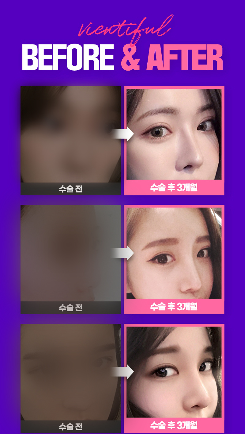 자연스러운코성형 만족도 높은 결과를 위해서는 관련 이미지 4