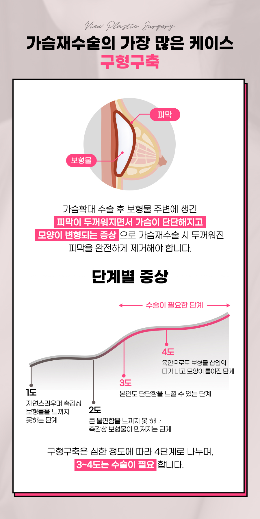 가슴재수술 고민중이라면? 관련 이미지 5