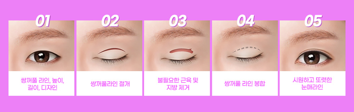 나만의 눈성형을 위한 수술방법 알아보기 관련 이미지 4