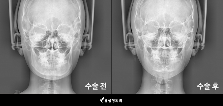 안면비대칭! 뷰에서 해결해봐! 관련 이미지 5