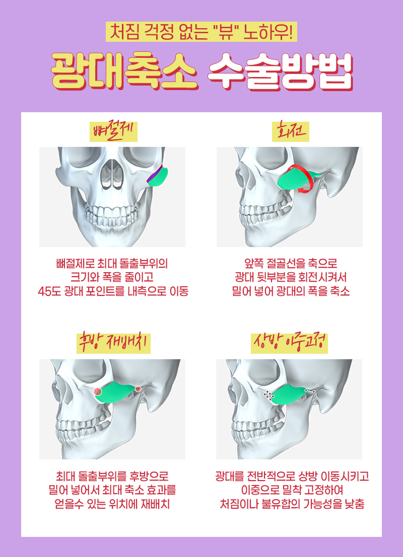 안면윤곽비용 걱정하기 보다는 관련 이미지 4