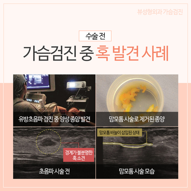 가슴수술 전후 가슴검진의 필요성! 관련 이미지 6