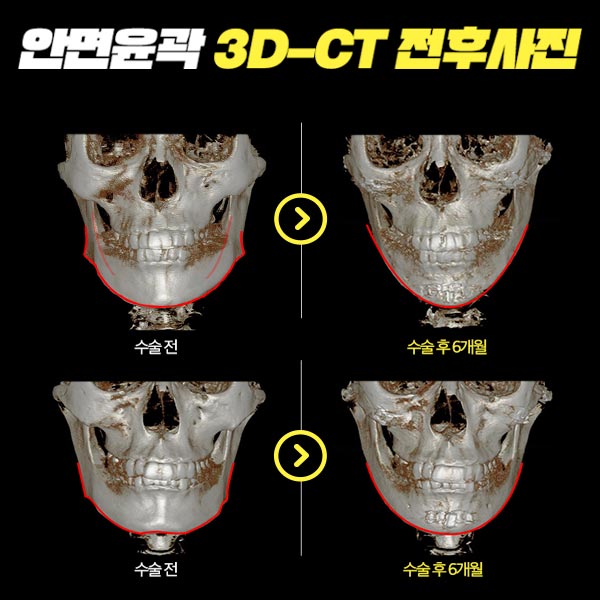 남자안면윤곽수술 의 핵심은! 관련 이미지 7