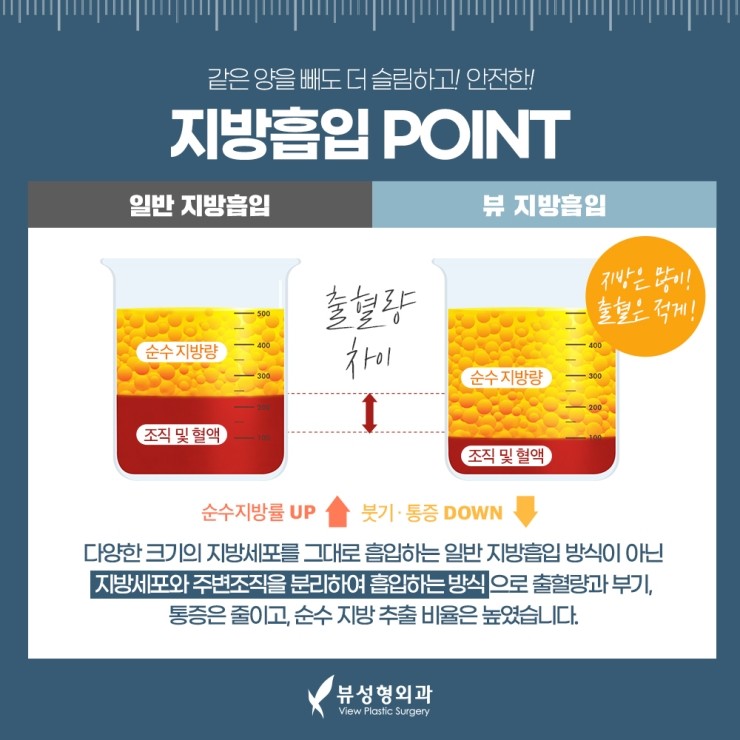 지방흡입, 체중감량술이 아닌 체형교정술 관련 이미지 6