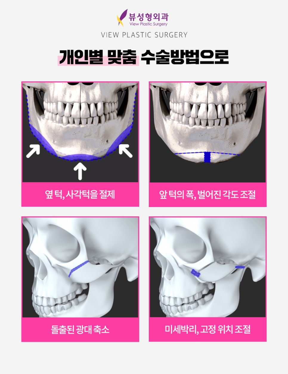 안면윤곽후기, 붓기는 얼마나 갈까? 관련 이미지 7