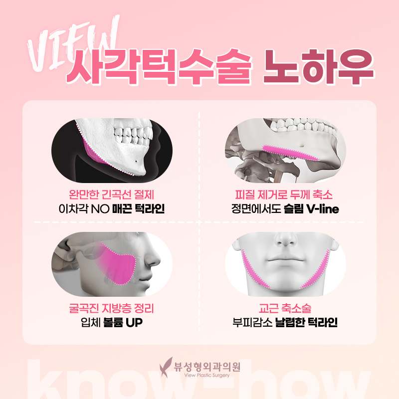 안면윤곽가격 정확히 알아보려면? 관련 이미지 6