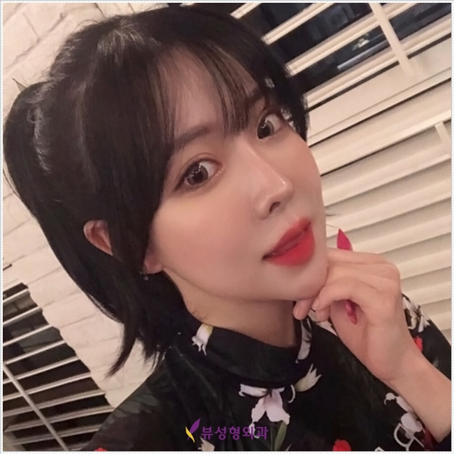 더 이상의 실패 없는, 뷰성형외과 코재수술 관련 이미지 1