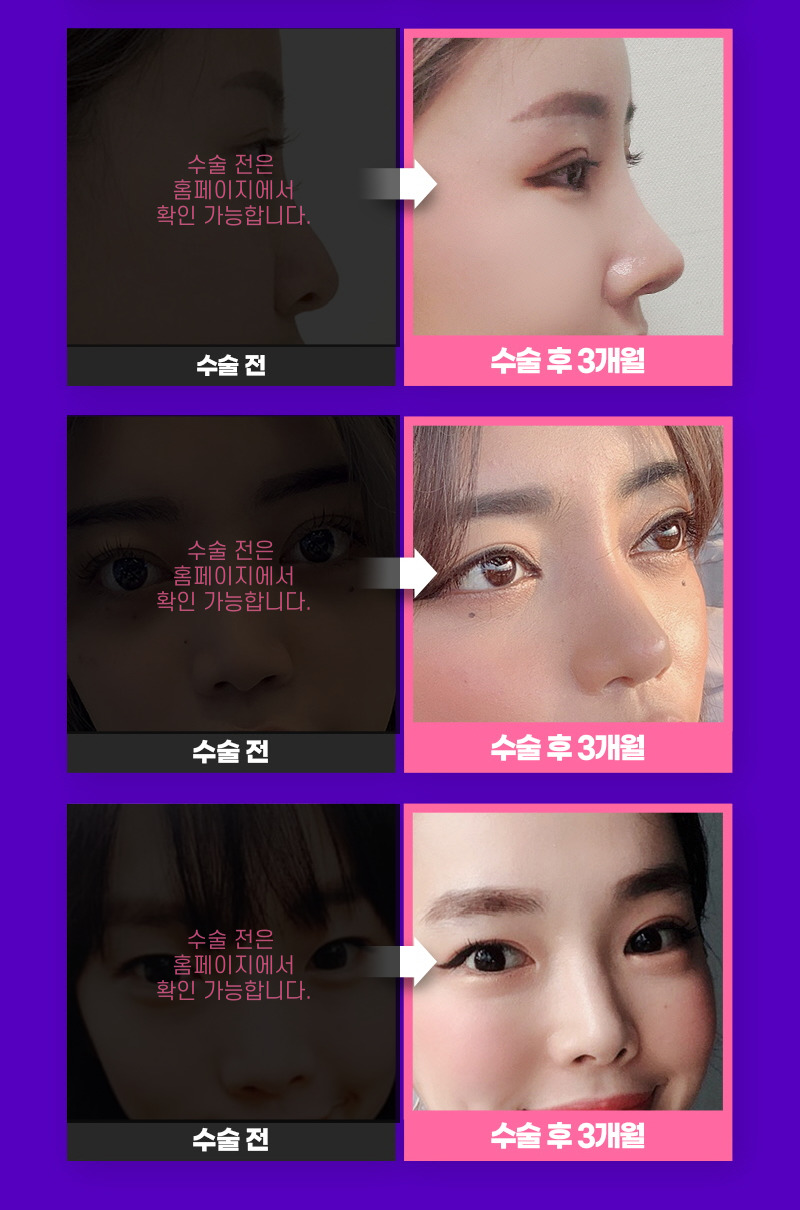 코성형, 개인별 유형에 적합한 수술방법은? 관련 이미지 11