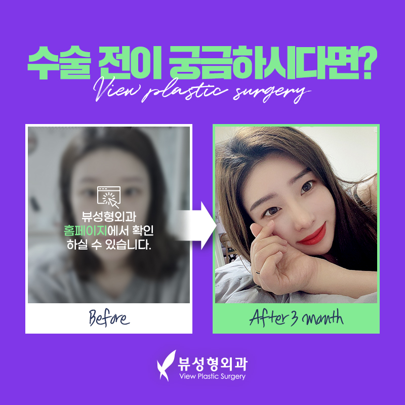 밋밋한 얼굴을 볼륨감 있게 입체적으로 개선하는 지방이식 관련 이미지 10