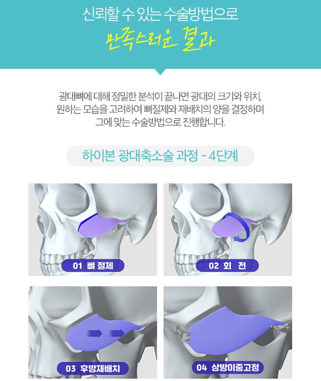 옆광대축소 작은얼굴 바란다면 관련 이미지 9