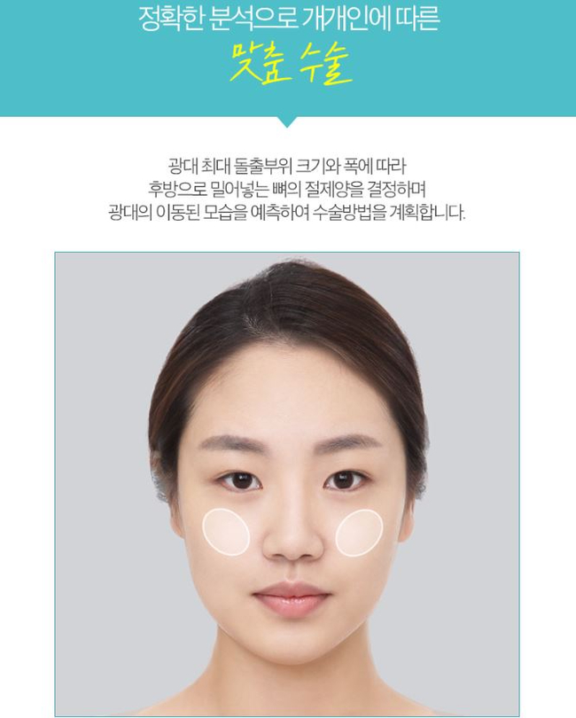 옆광대축소 작은얼굴 바란다면 관련 이미지 8