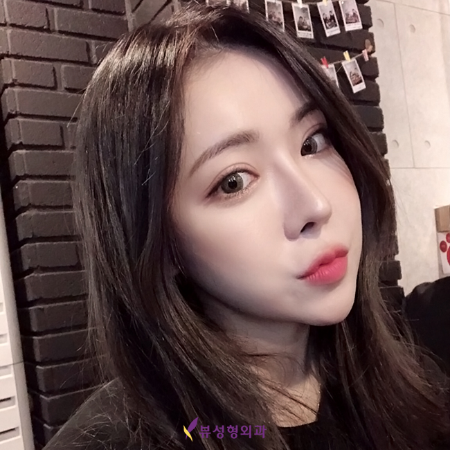 수술 후 관리까지 꼼꼼한 뷰티풀 코성형 관련 이미지 7